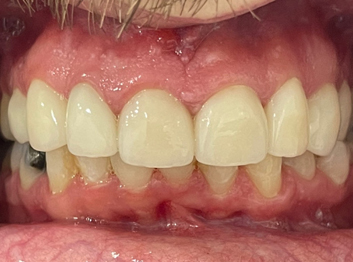 After - Partington Dental