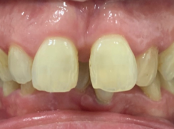 Before - Partington Dental