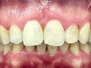 After - Partington Dental