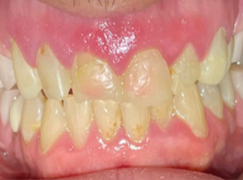 Before - Partington Dental